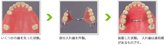 入れ歯の治療のイメージ